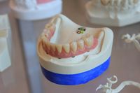 Повече за  зъбни импланти цени 6